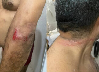 Motociclista fica ferido após colidir com fios caídos na rua Capim Grosso, no Marechal Rondon